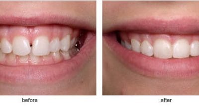 Revitalise Your Teeth with Composite Bonding