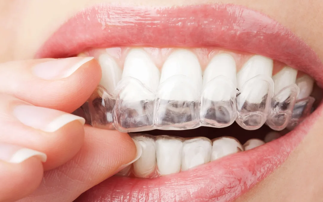 invisalign Dentist Aberdeen