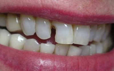 How to Whiten Fillings on Front Teeth