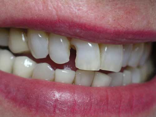 whiten fillings on front teeth