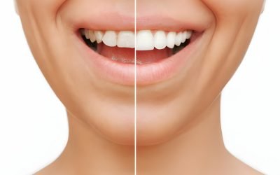 Do I Brush My Teeth Before Whitening Strips?Complete Guidence