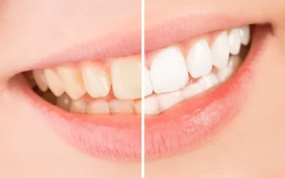 How To Treat Burned Gums From Teeth Whitening? Complete Guidence