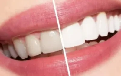 A Comprehensive Guide to Teeth Whitening in the UK