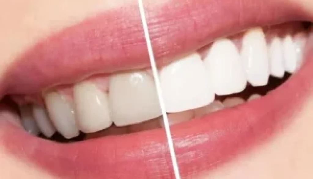 teeth whitening