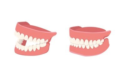 How Much Are Implant Dentures With Insurance? Complete Guidence