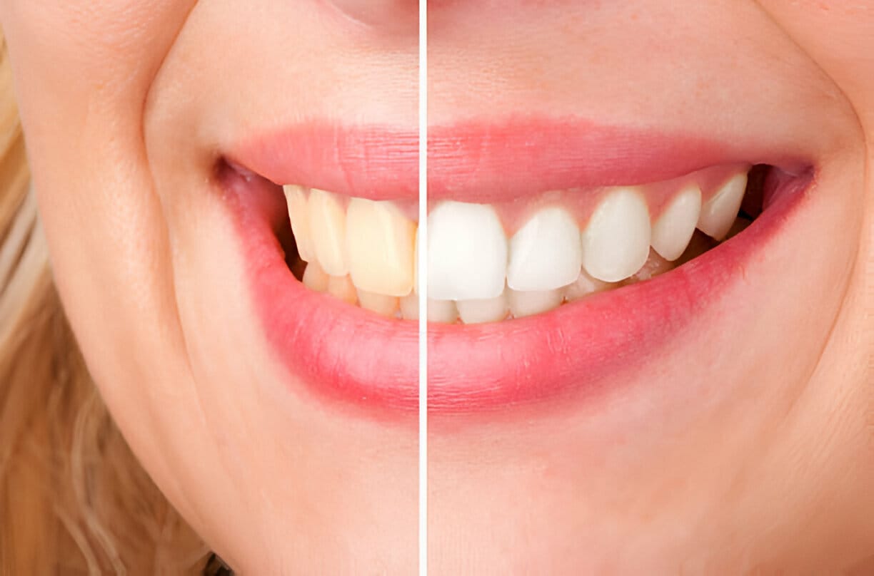 What Can I Eat After Teeth Whitening?