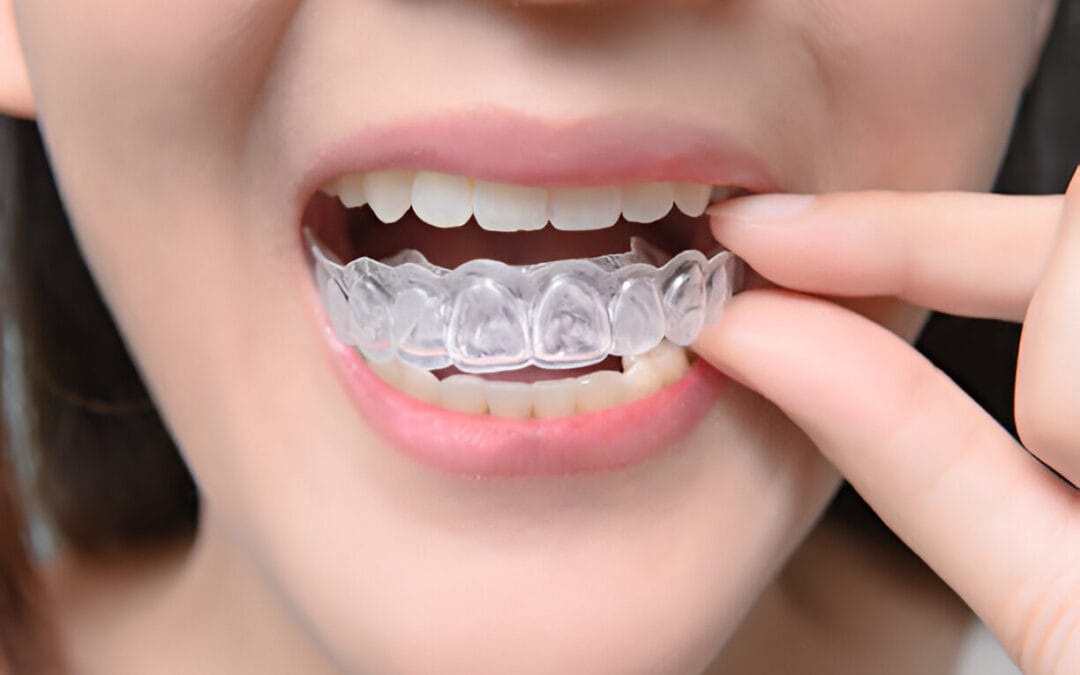 Invisalign
