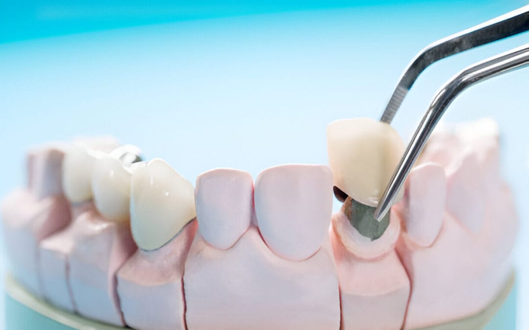 Invisalign with a Crown