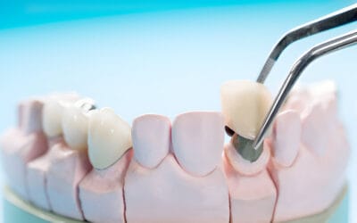 Can You Get Invisalign with a Crown? Complete Guidance