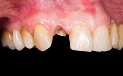 How Long Can a Dead Tooth Stay in Your Mouth?