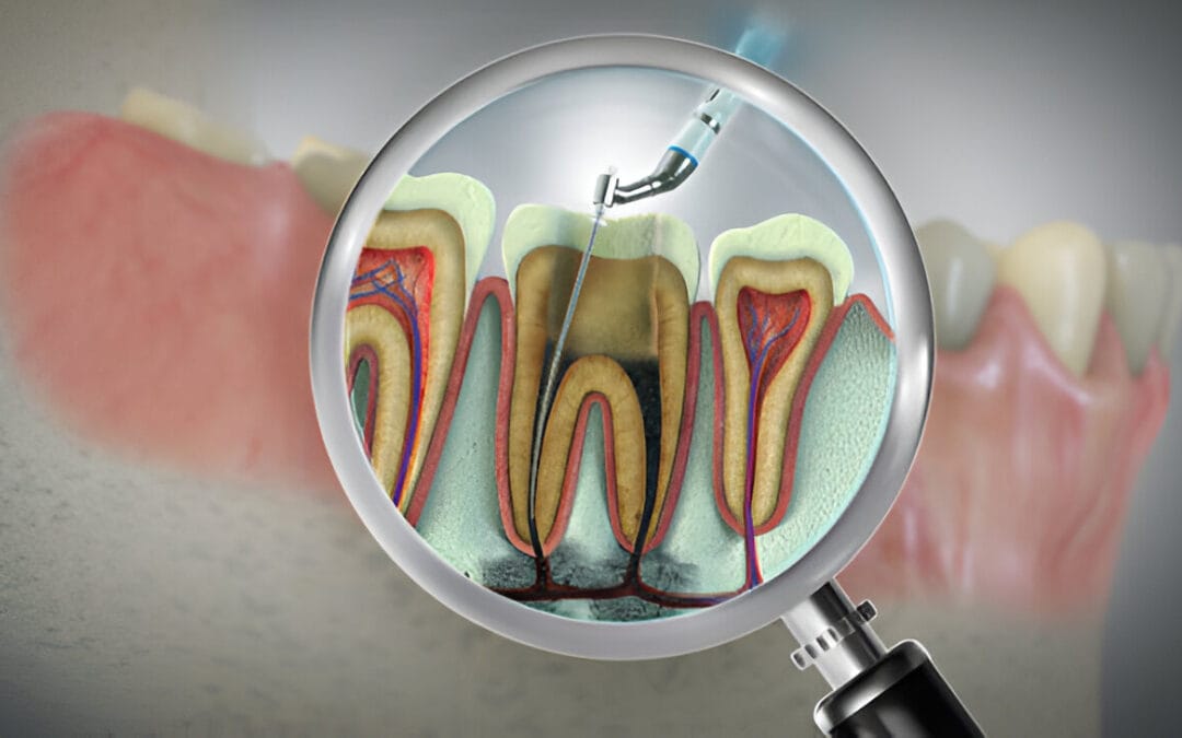 Root Canals