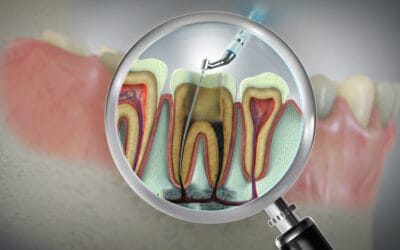 Are Root Canals Covered by the NHS?