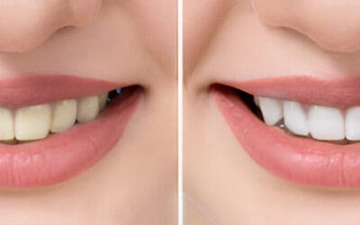 Does a Scale and Polish Whiten Your Teeth? Complete Guidance