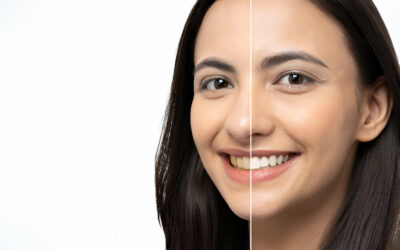 How Much Is Teeth Whitening in Scotland?