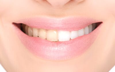 What are the different teeth whitening options available in Aberdeen?
