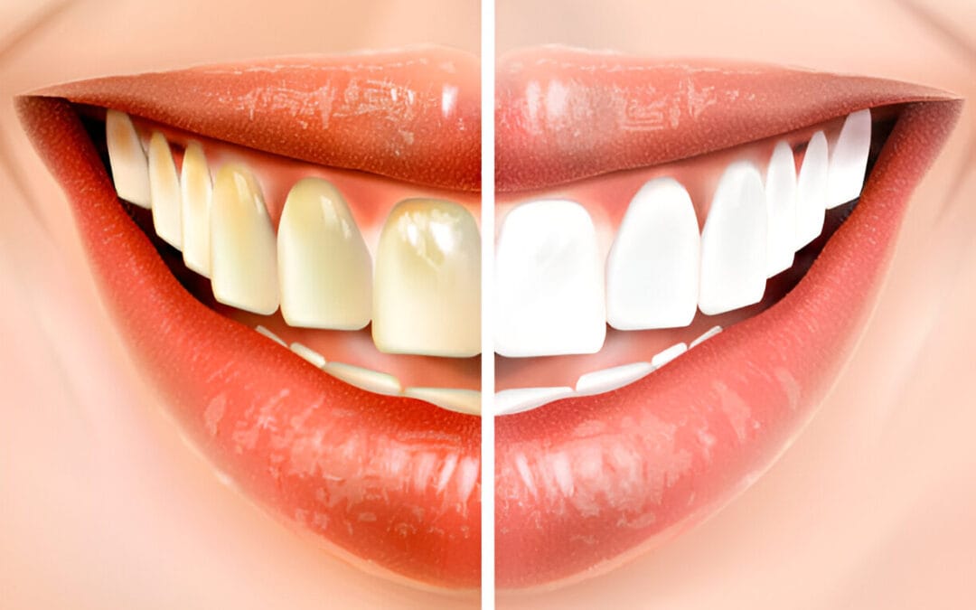 teeth whitening