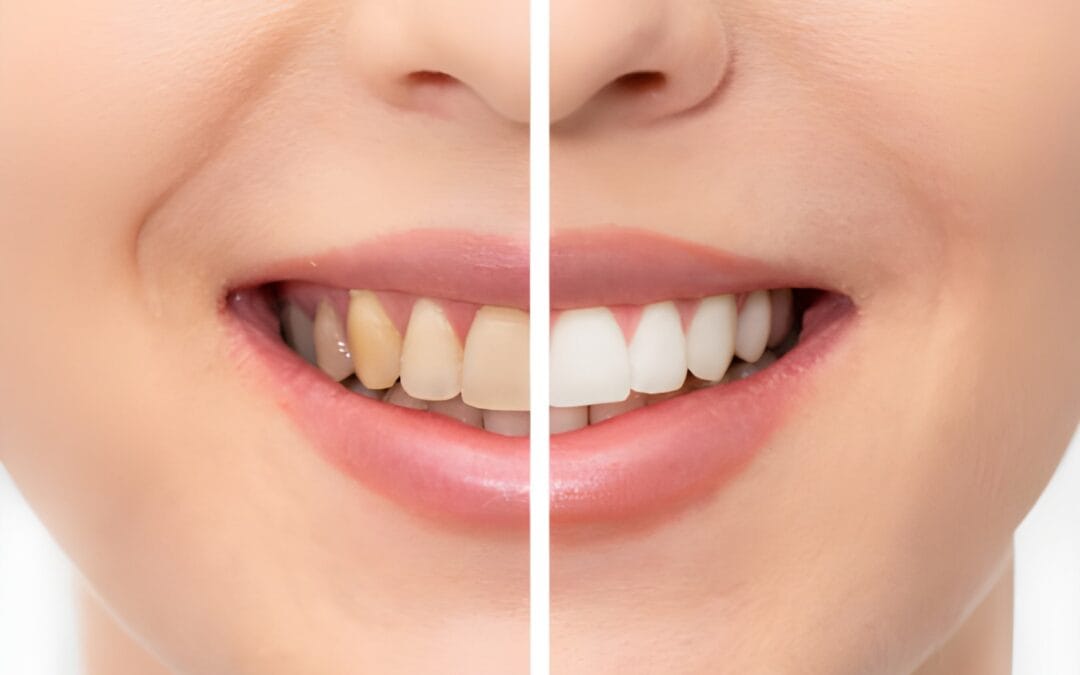 teeth whitening