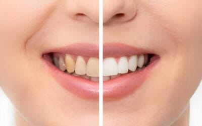 Are there any risks or side effects associated with teeth whitening in Aberdeen?