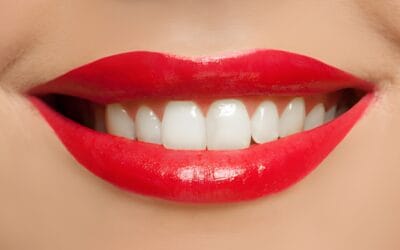 Are there any foods or drinks to avoid after teeth whitening in Aberdeen?