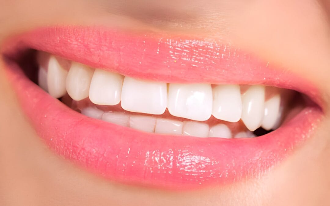 teeth whitening