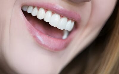 Are there any foods or drinks to avoid after teeth whitening in Aberdeen?