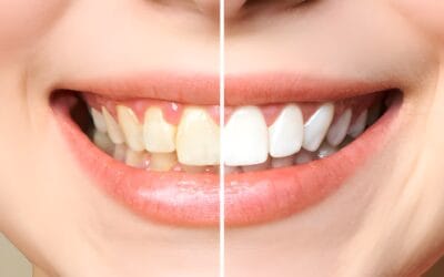 What should I do if I experience tooth sensitivity after teeth whitening in Aberdeen?